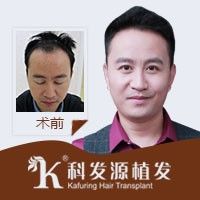 国内哪家种植头发的医院效果好 图片 4
