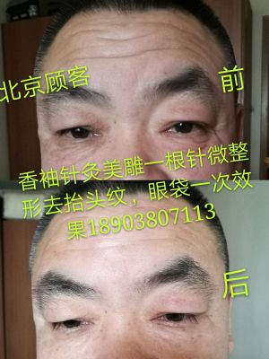香袖针灸美雕一根针微整形 NJ 图片 3
