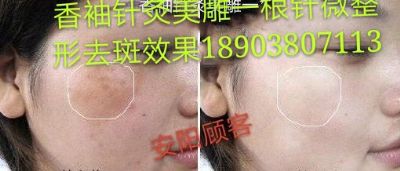 香袖针灸美雕一根针微整形 NJ 图片 8