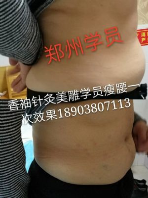 香袖针灸美雕一根针微整形 NJ 图片 9