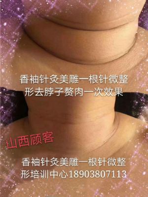 香袖针灸美雕一根针微整形 NJ 图片 10
