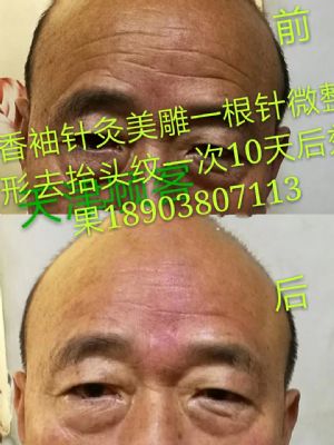 香袖针灸美雕一根针微整形 NJ 图片 1