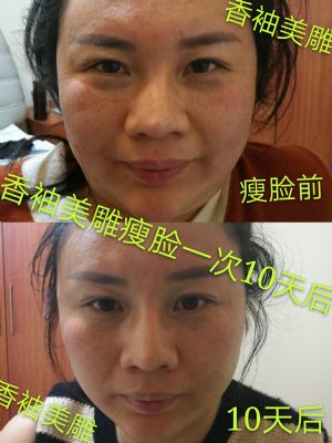 香袖针灸美雕一根针微整形 NJ 图片 7