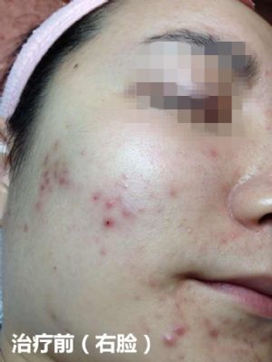 纽约法拉盛中药治痘,1天见效,20天包好 photo 3