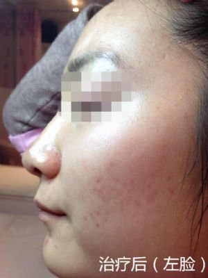 纽约法拉盛中药治痘,1天见效,20天包好 photo 7
