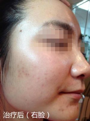 纽约法拉盛中药治痘,1天见效,20天包好 photo 4