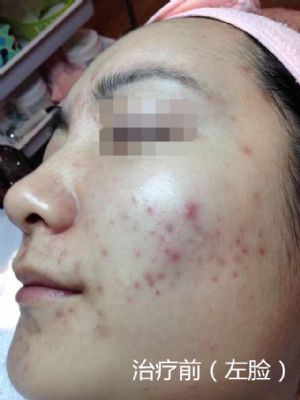 纽约法拉盛中药治痘,1天见效,20天包好 photo 5