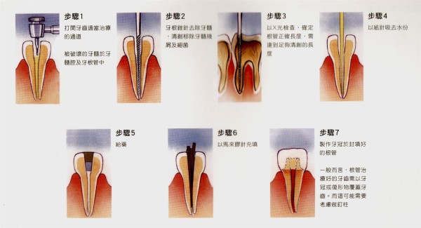 梁家豪牙科根管治療專科 图片 1