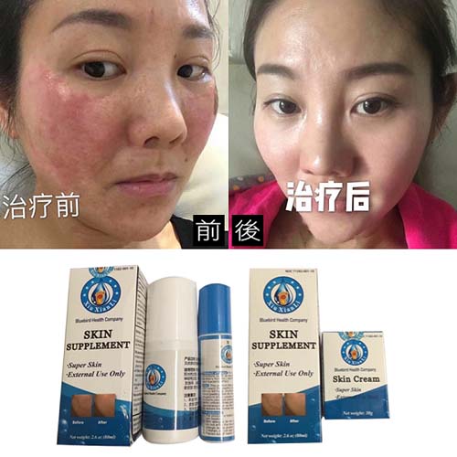 灰指甲‧手足癬 图片 6