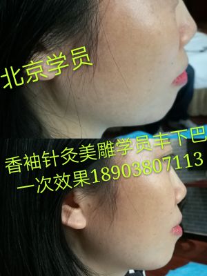 香袖针灸美雕一根针微整形 NJ