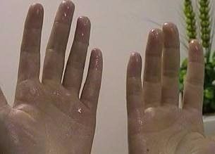 如何治疗多汗症？