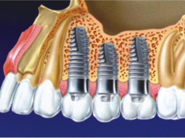 凌甡牙醫博士─人工植牙專科